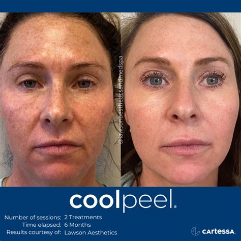 CoolPeel® CO2 Laser Treatment .